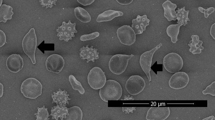 باحثة عُمانية توضح حول طفرة جينية نادرة في الخلايا الحمراء العُمانية